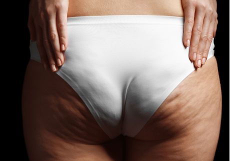 Guida Completa alla Cellulite – Rimedi Antichi e Bisogni Moderni